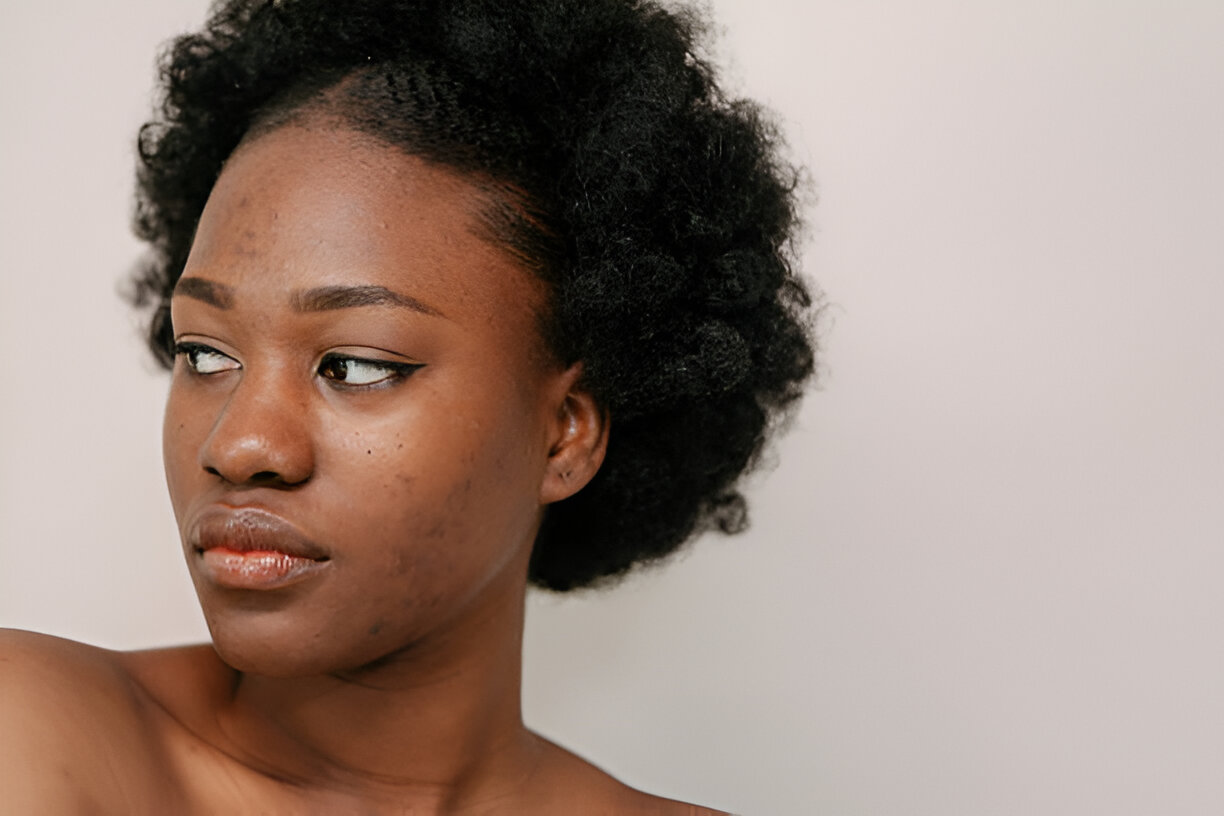 Top 7 Causes of Adult Acne and How to Treat Them